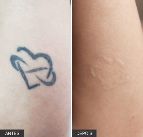resultado de remoção de tatuagem com o Inkie Laser