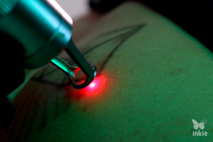 Foto com foco a aplicação de um dos métodos para remover tatuagem mais usados: o laser do Inkie