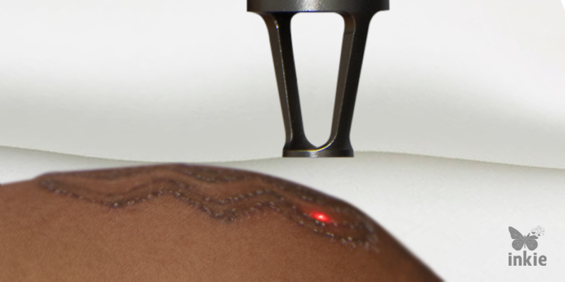 Imagem mostrando a aplicação do Inkie Laser, o melhor aparelho para quem quer trabalhar com remoção de tatuagem