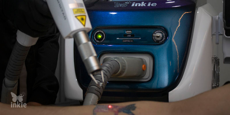 Inkie Laser, o melhor equipamento do mercado de remoção de tatuagem