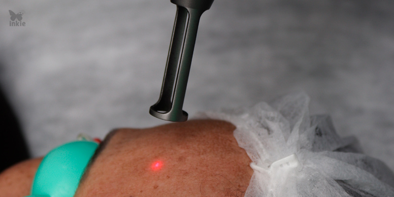 Melasma sendo tratado com o Inkie Laser