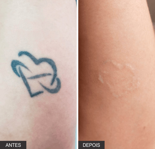 resultado-antes-e-depois-inkie-laser