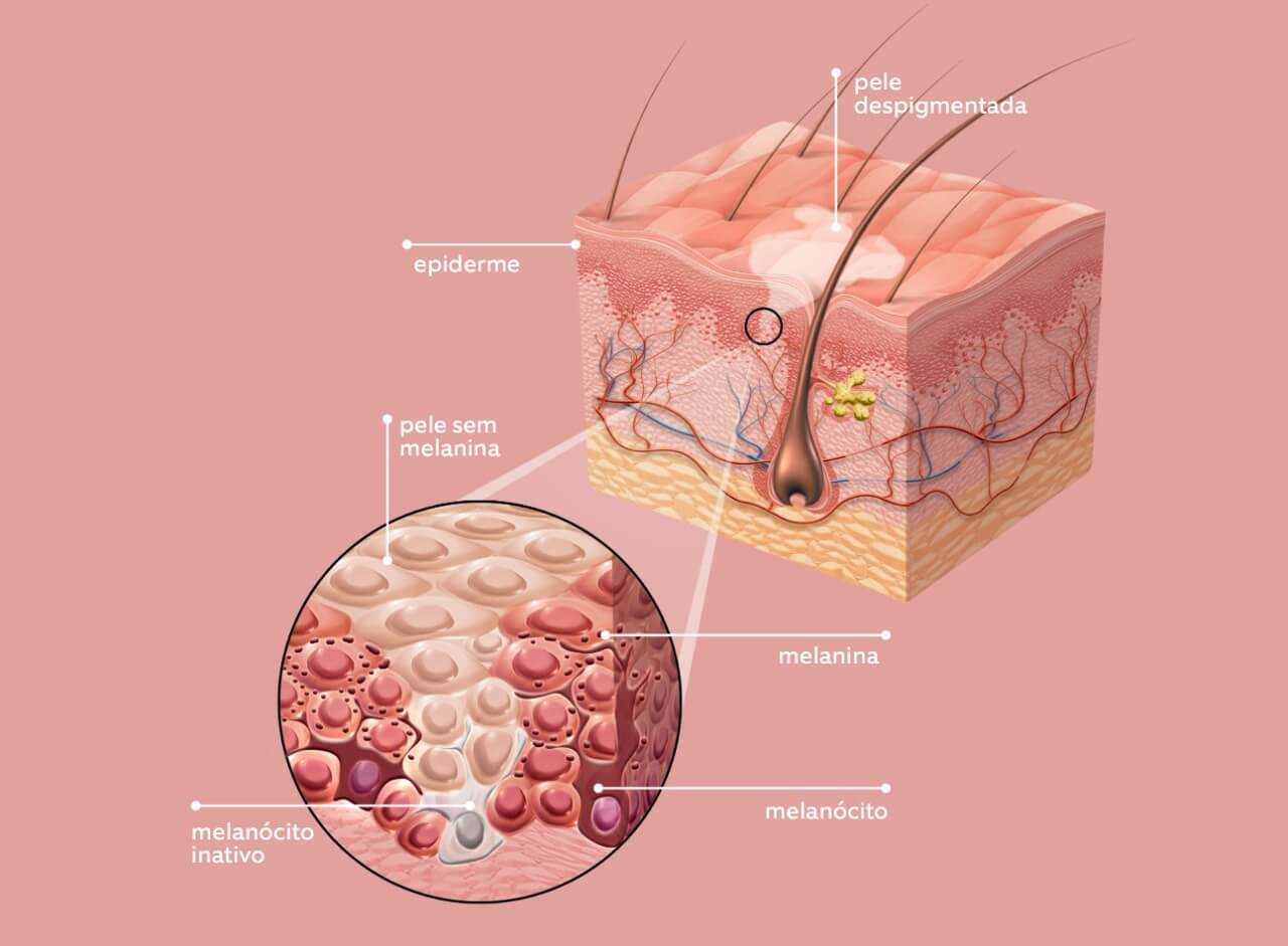 Esquema de vitiligo