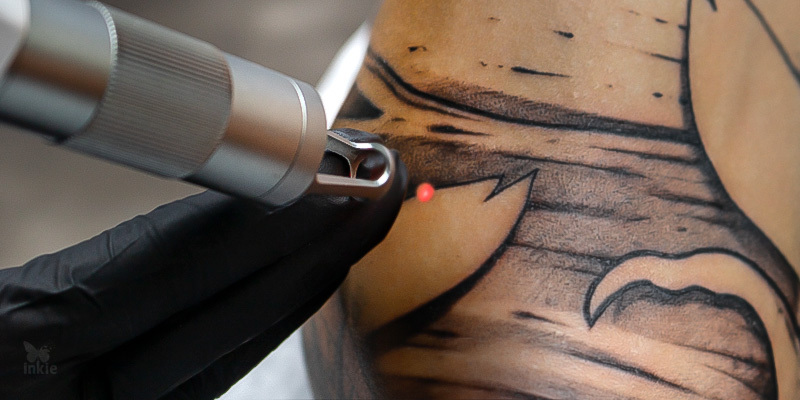 procedimento de remoção de tatuagem a laser