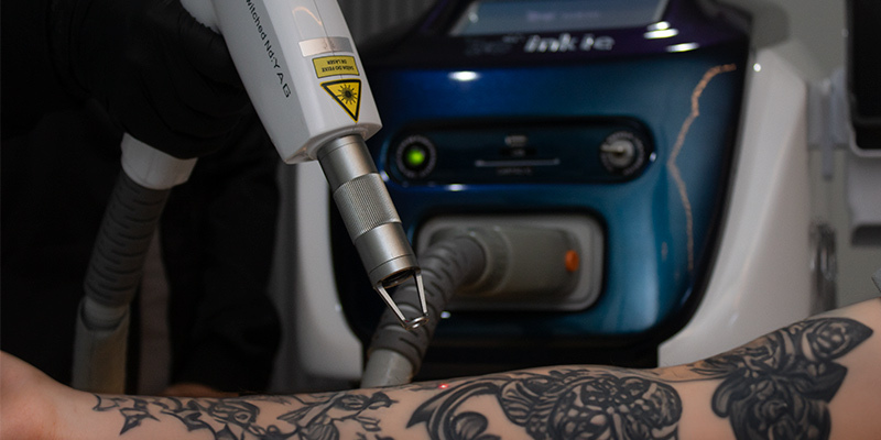 Sessão com o aparelho Inkie Laser sendo realizada para remoção de tatuagem