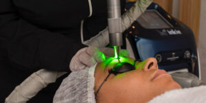 Mulher realizando sessão para remover micropigmentação a laser na sobrancelha